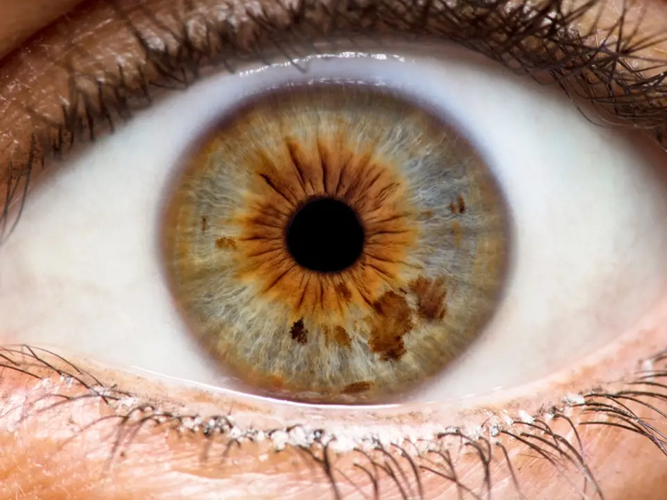 Iridologie se zabývá  diagnózou zdravotního stavu jedince podle obrazu duhovky jeho oka.