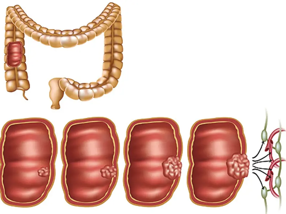 Karcinom tlustého střeva vzniká v naprosté většině zhoubnou přeměnou adenomového polypu