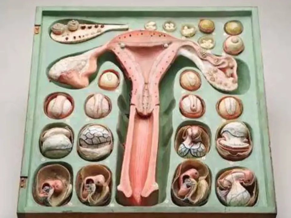 Gynekologický model z roku 1880