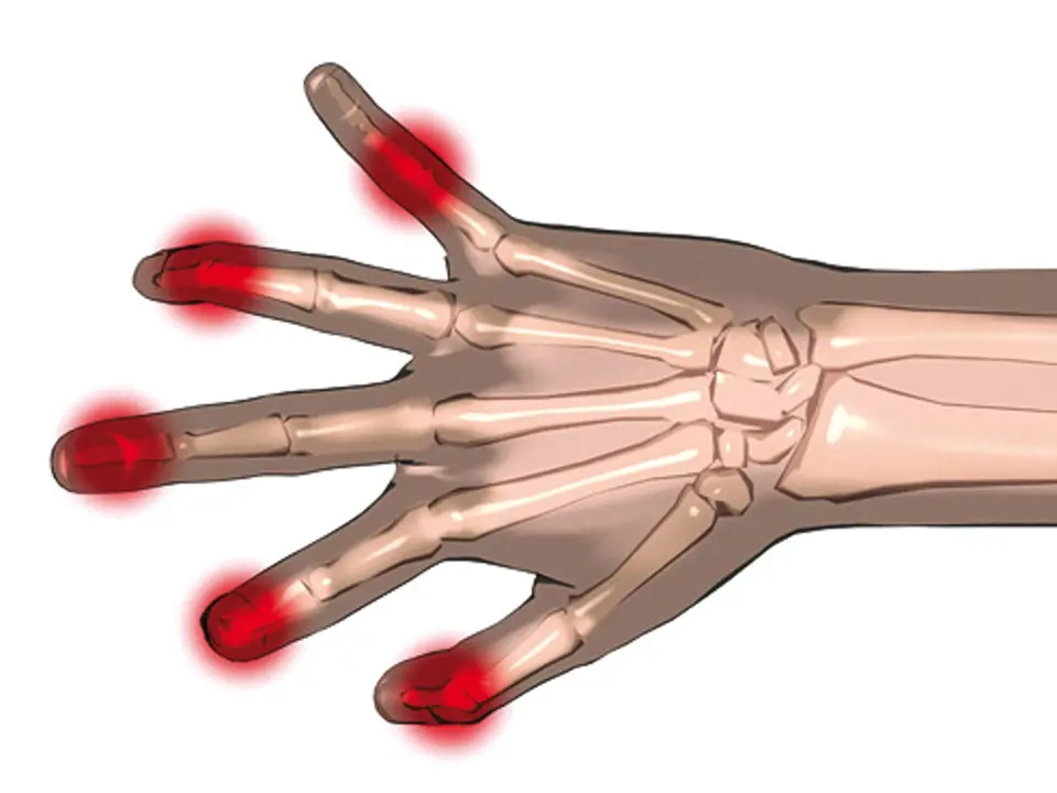 Artrózou postižené klouby na rukou jsou bolestivé a zduřelé.