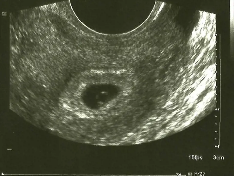 Ultrazvuk v šestém týdnu už bude jasný.