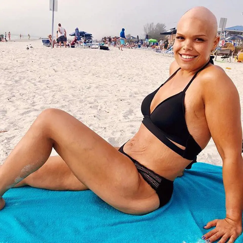 Jessica kvůli léčbě rakoviny přišla o vlasy, ne však o bojovnost.