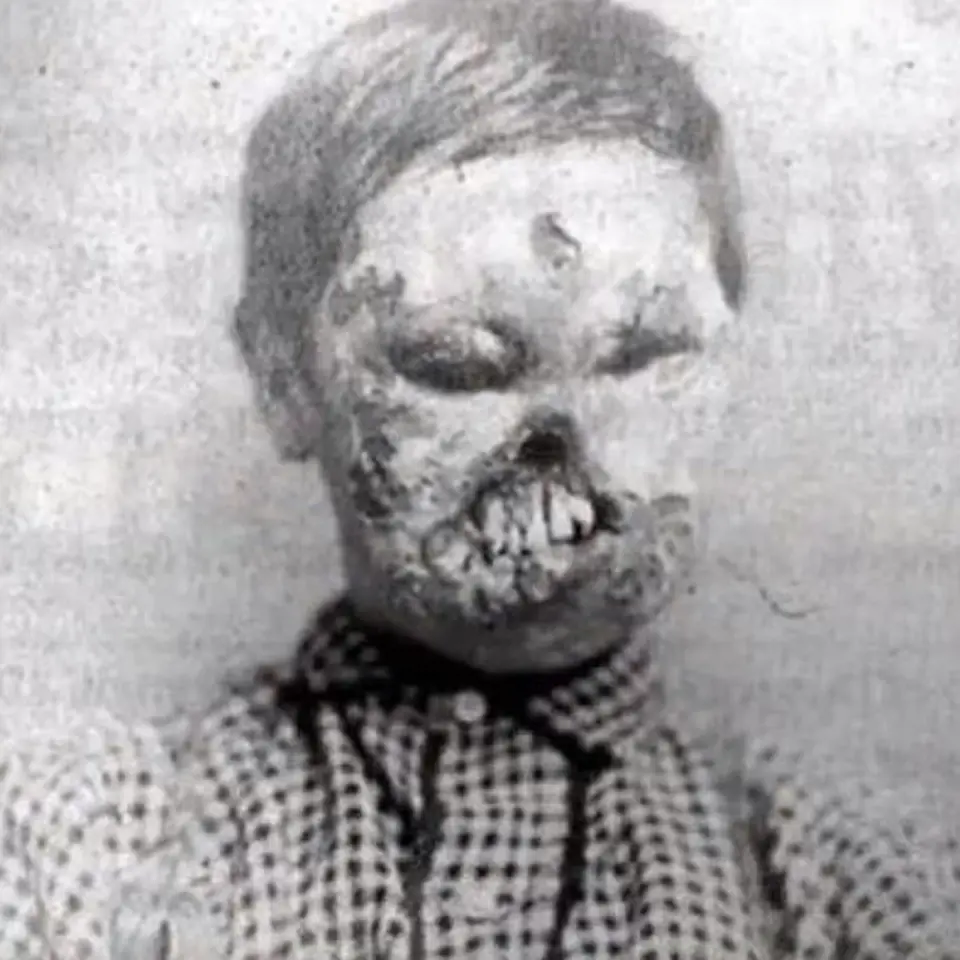 Chlapec, u kterého došlo během porodu o přenos syfilisu. Podobně postiženým pomohl vynález penicilinu.