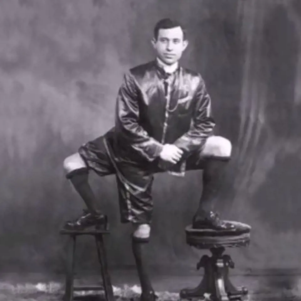 Francesco Lentini byl známý jako muž se třemi nohami. Jeho siamské dvojče na něm parazitovalo v podobě třetí nohy a genitálií.