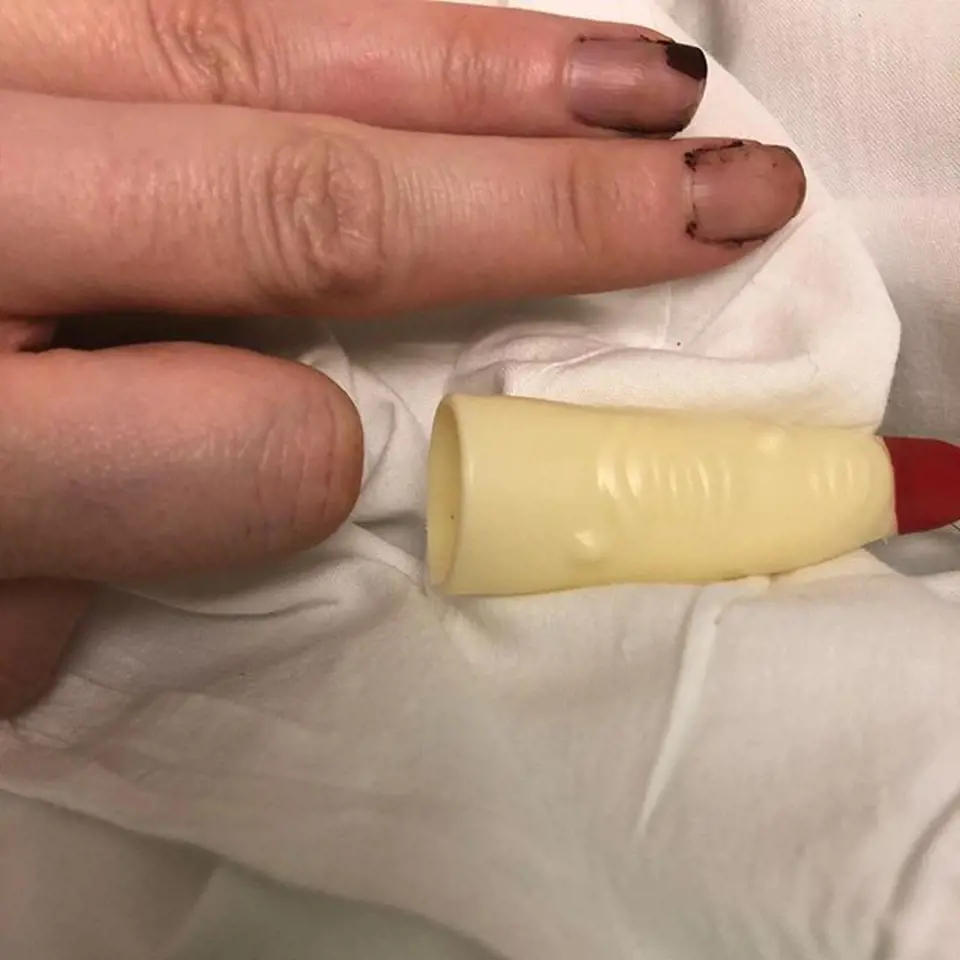 Prodělala tři operace, na menší torzo prstu se mohla nandat protéza. Bohužel došlo k nekróze zbytku prstu a záchrana nebyla možná.