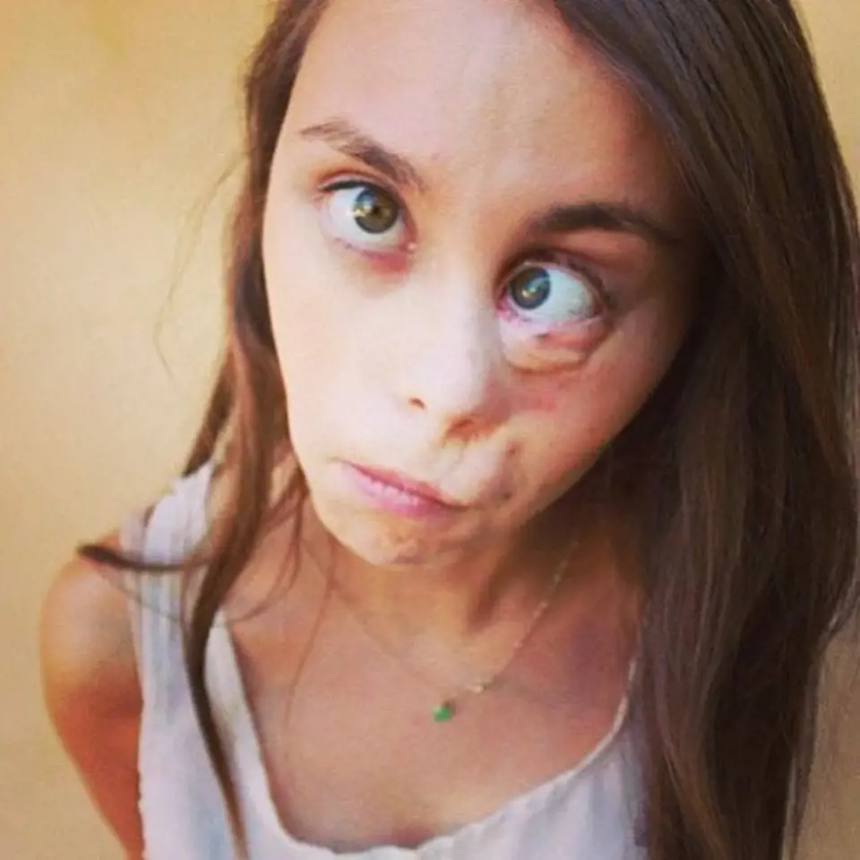 Isabella Welch má rozštěp a trpí Ehlers-Danlosovým syndromem.