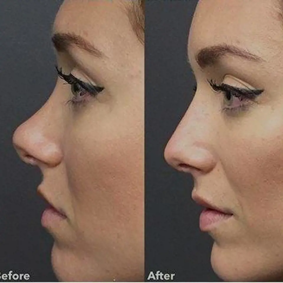 Když operace nosu totálně změní život