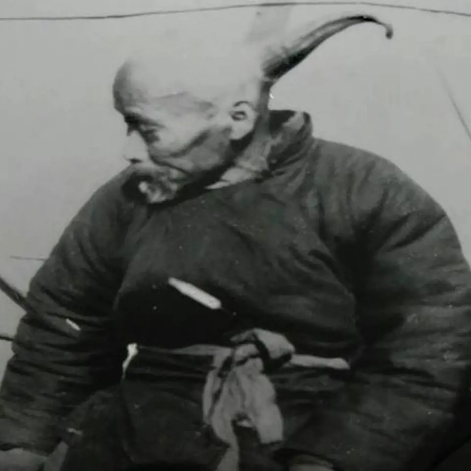 Wang - Lidský jednorožec. Tomuto Číňanovi vyrůstal z hlavy 33 cm dlouhý roh.